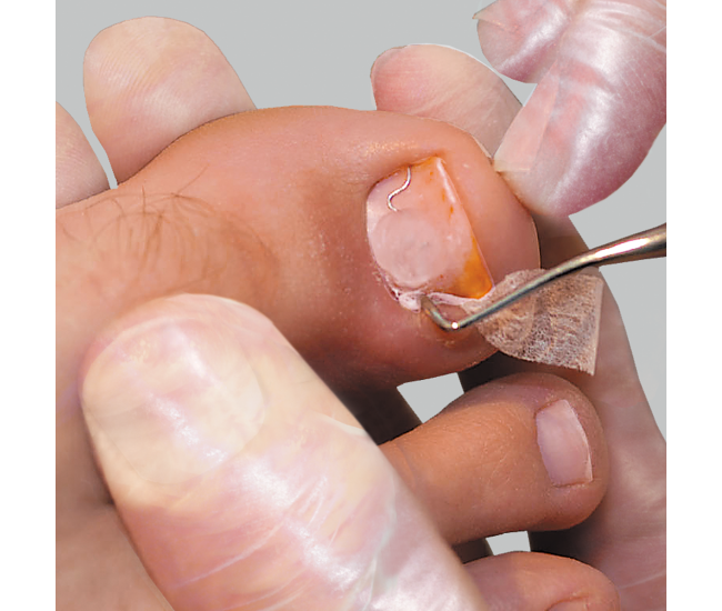 Nail edge tamponade